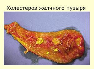 Холестерин в желчном пузыре