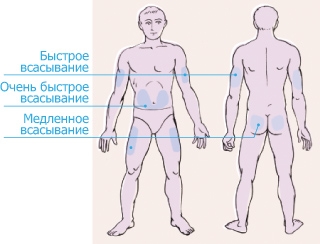 Места для введения инъекций инсулина